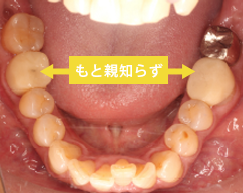 親知らずの抜歯で起こり得るその他の副作用