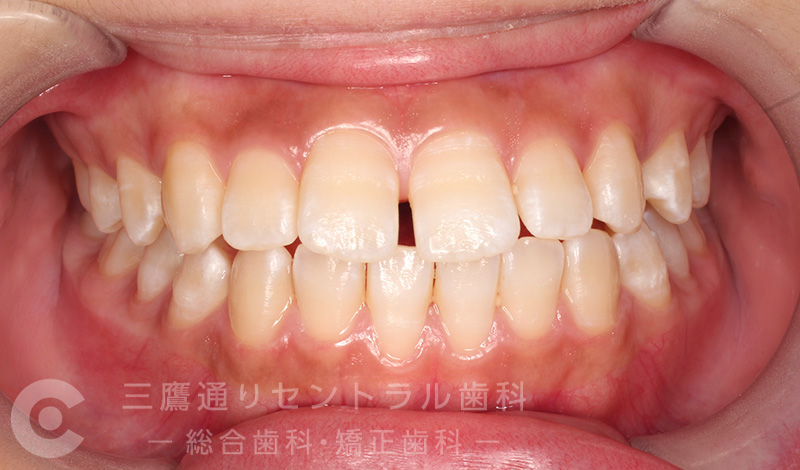 Before