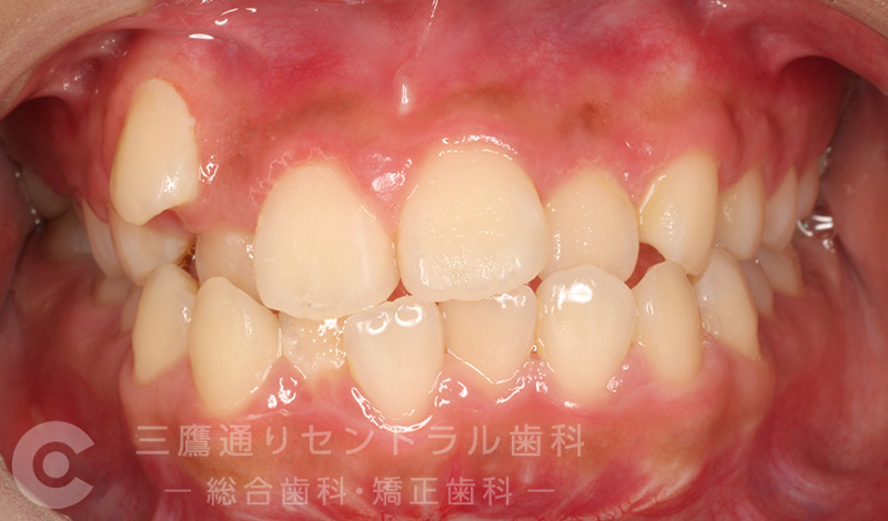 Before