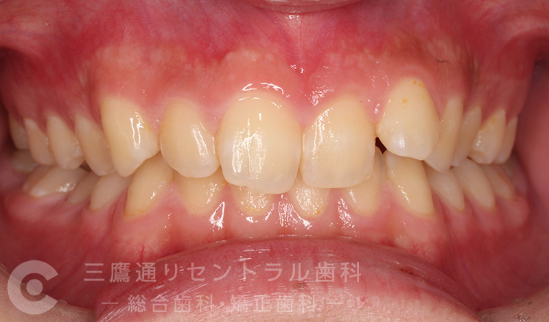 Before
